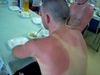 Sunburn